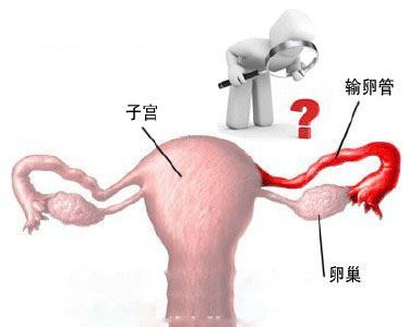 女性输卵管堵塞有什么症状？