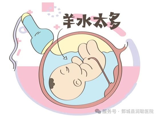 怀孕那点事----羊水过多