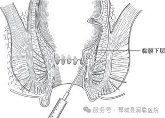 难以启齿的困扰：全面认识痔，告别尴尬与焦虑