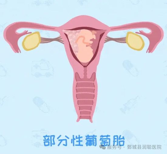 葡萄胎:一种特殊的妊娠