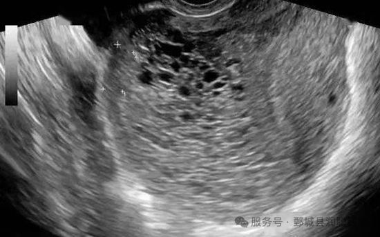 葡萄胎:一种特殊的妊娠