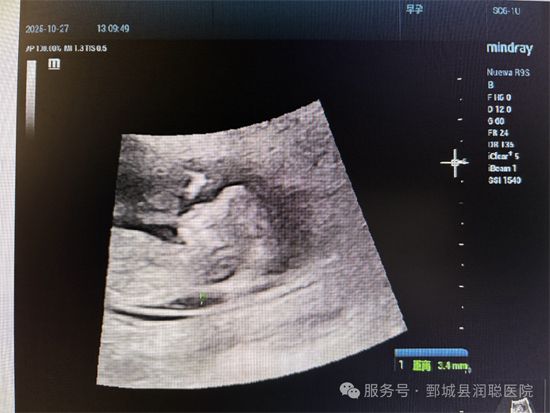 【健康科普】孕早期必看：NT检查——宝宝的第 一道“健康安检”