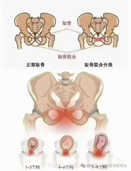 产后三大部位.盆底肌+腹直肌+骨盆，修复攻略你知道多少？