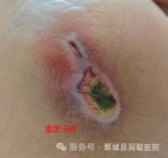 【健康科普】原来“躺平”也有压力