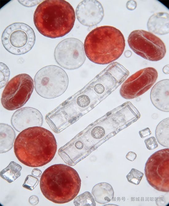 【健康科普】一滴尿里的健康密码：尿沉渣显微镜检查全解析