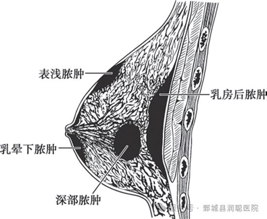 【健康科普】急性乳腺炎：新手妈妈需要了解的乳腺问题
