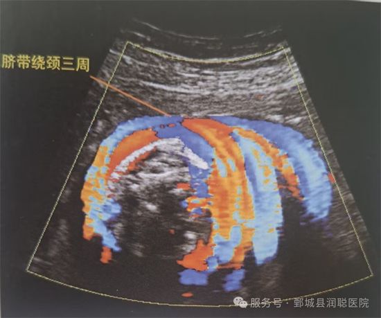 【健康科普】守护生命纽带——脐带异常的超声早发现