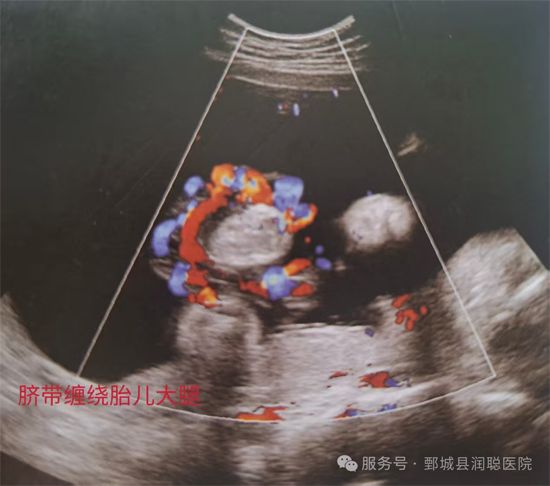 【健康科普】守护生命纽带——脐带异常的超声早发现
