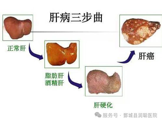 【健康科普】别让肝脏“发福”——聊聊脂肪性肝病
