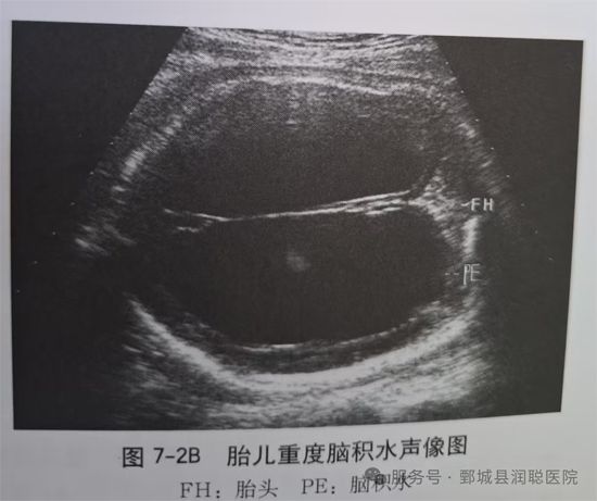 【健康科普】胎儿脑积水：超声诊断里的那些关键知识点