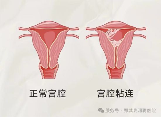 【健康科普】备孕路上的拦路虎——宫腔粘连