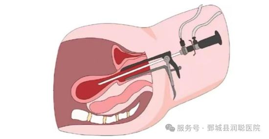 【健康科普】备孕路上的拦路虎——宫腔粘连
