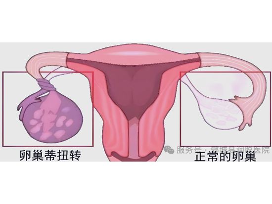 【健康科普】附件扭转：警惕致命“卵巢急刹车”