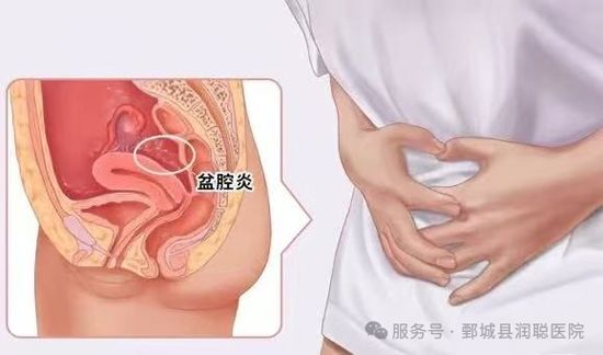 【健康科普】女性健康的“隐形杀手”：全面了解盆腔炎