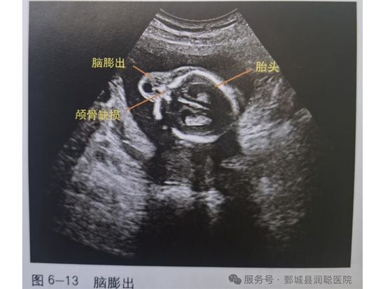 【健康科普】孕期超声科普：读懂胎儿脑膜膨出与脑膨出