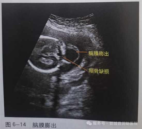 【健康科普】孕期超声科普：读懂胎儿脑膜膨出与脑膨出
