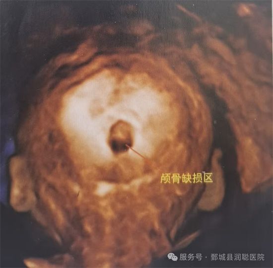【健康科普】孕期超声科普：读懂胎儿脑膜膨出与脑膨出