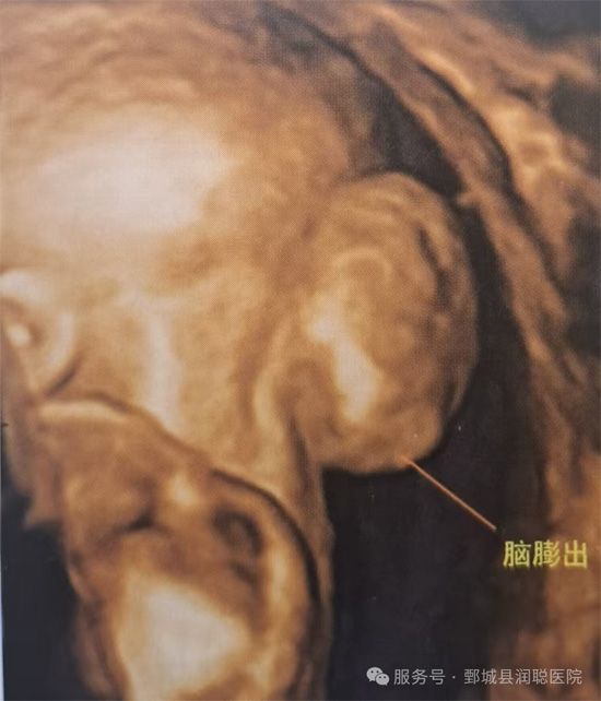 【健康科普】孕期超声科普：读懂胎儿脑膜膨出与脑膨出