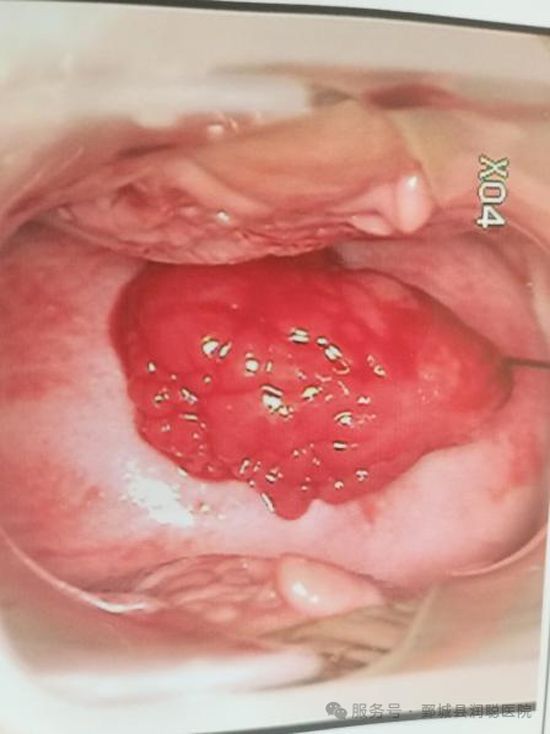 【健康科普】宫颈赘生物:不用过度恐慌,科学认识正确应对