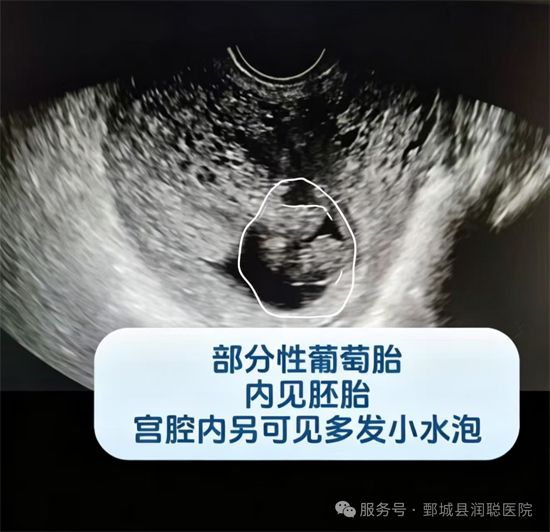 【健康科普】葡萄胎知多少，经阴道超声助力早识别