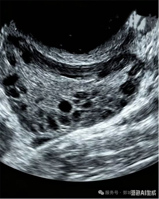 【健康科普】超声带你认识多囊卵巢综合征