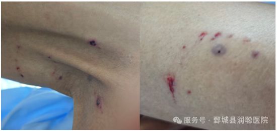 【健康科普】狂犬病:从咬伤到预防,你必须知道的事