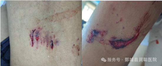 【健康科普】狂犬病:从咬伤到预防,你必须知道的事