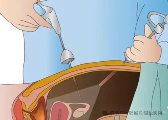 【健康科普】卵巢畸胎瘤：是“怪胎”还是“肿瘤”？一篇讲明白——张芳芳医师
