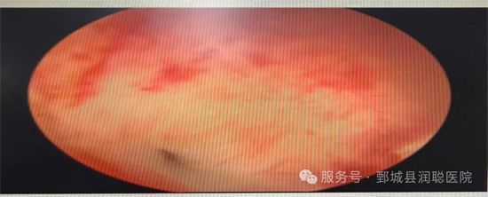 【健康科普】子宫内膜炎:关于子宫“土壤”的炎症,你了解多少?——李淑霞