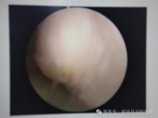 【健康科普】藏在宫腔里的“小异物”——带你读懂黏膜下子宫肌瘤——邵凤霞