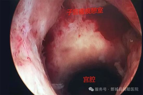 【健康科普】剖宫产留下的“小坑”怎么修？一篇讲懂宫腔憩室修补术——冯亚清