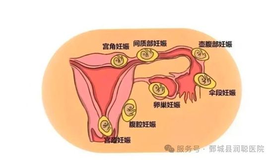 【健康科普】怀了“双胞胎”，却一个在宫内一个在宫外？带你认识“复合妊娠”——李慧医师