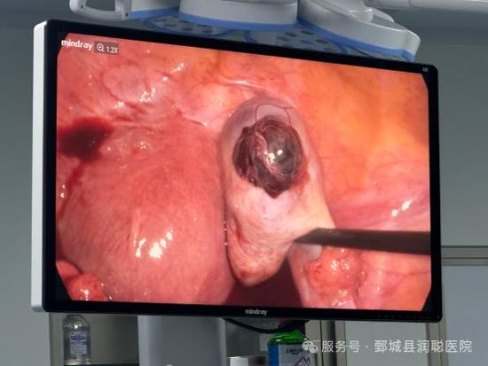【健康科普】怀了“双胞胎”，却一个在宫内一个在宫外？带你认识“复合妊娠”——李慧医师