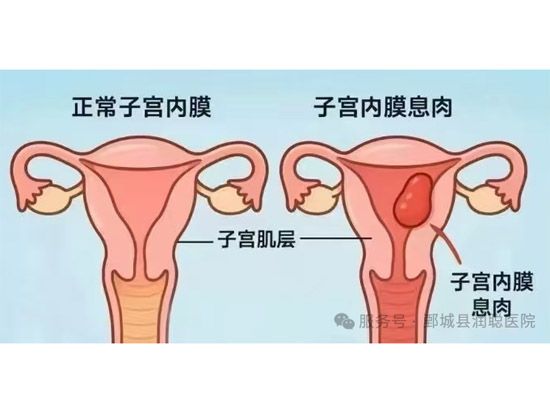 【健康科普】子宫内膜息肉：子宫里长出的“小肉疙瘩”，你了解多少？——冯亚清