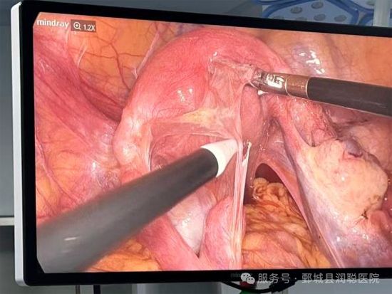 【健康科普】“钥匙孔手术”妇科腹腔镜——李淑霞