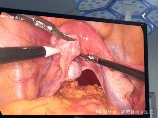 【健康科普】“钥匙孔手术”妇科腹腔镜——李淑霞
