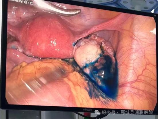 【健康科普】“钥匙孔手术”妇科腹腔镜——李淑霞