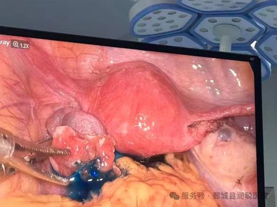 【健康科普】“钥匙孔手术”妇科腹腔镜——李淑霞