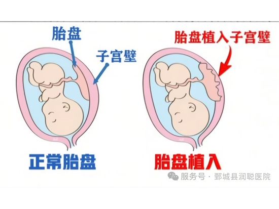 【健康科普】警惕胎盘植入风险，超声检查为孕期安全保驾护航——李凤娇