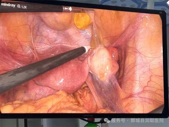 【健康科普】宫腹腔镜术后黄金恢复期：做好护理，杜绝复发——李萌