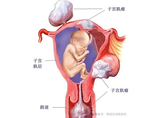 【健康科普】当怀孕遇上子宫肌瘤，该怎么办？——李凤娇  