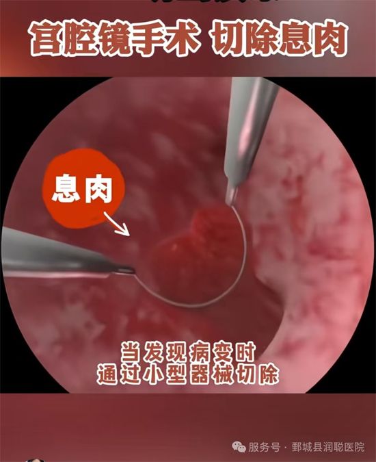 【健康科普】宫腔镜电切术：不开🔪，也能解决子宫里的“麻烦事”——张芳芳