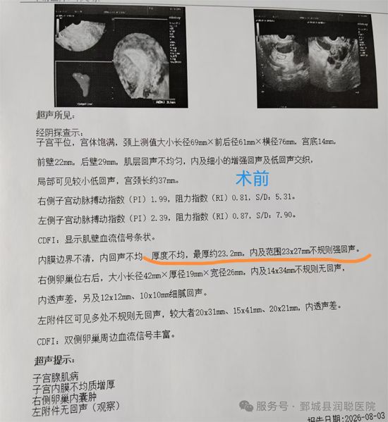 【健康科普】宫腔镜电切术：不开🔪，也能解决子宫里的“麻烦事”——张芳芳