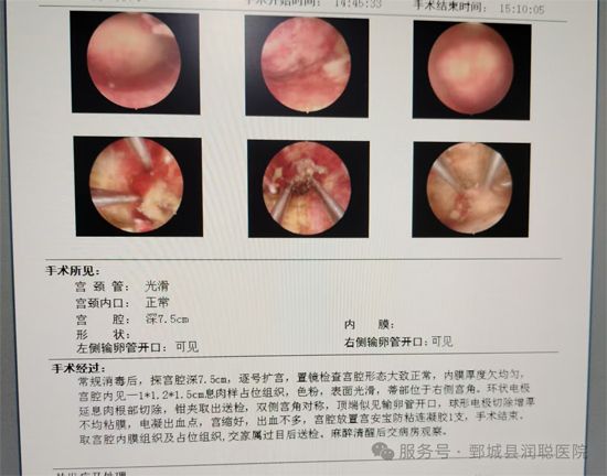 【健康科普】宫腔镜电切术：不开🔪，也能解决子宫里的“麻烦事”——张芳芳